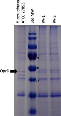 Acquisition of resistance to ceftazidime-avibactam during infection treatment in Pseudomonas aeruginosa through D179Y mutation in one of two blaKPC-2 gene copies without losing carbapenem resistance